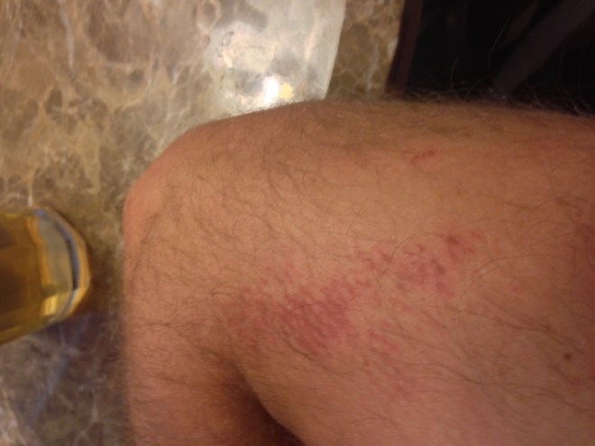 Right arm after yesterday's 100 ring push-ups