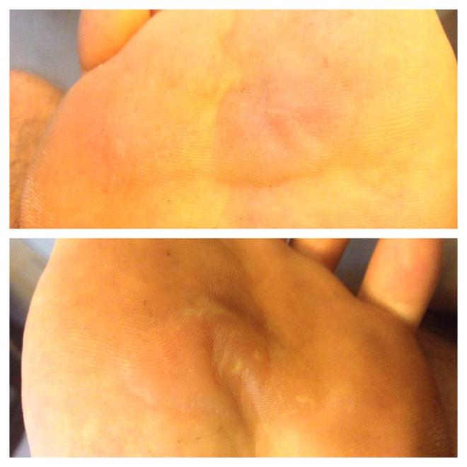 blisteres-feet